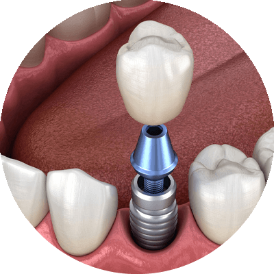 dental implant model