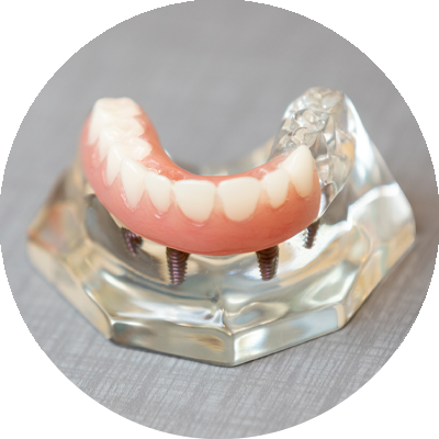 full arch dental implant model placed on counter