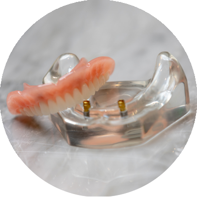implant supported denture model placed on counter