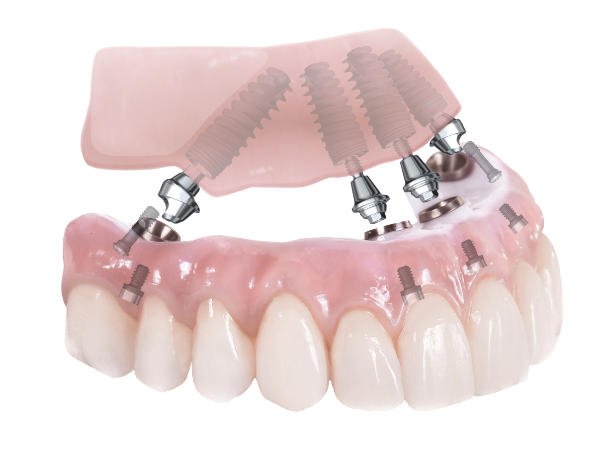 An image of an all-on-4- dental implant model.