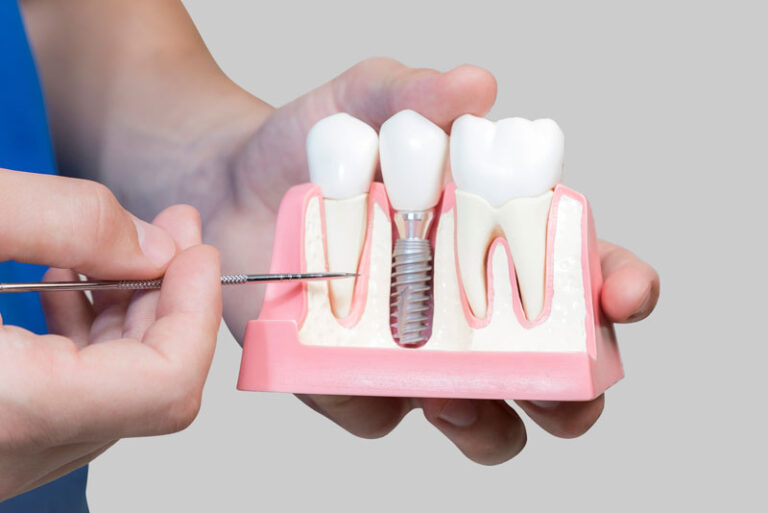 Wondering How Denture Implants In Houston, TX Can Benefit Your Smile