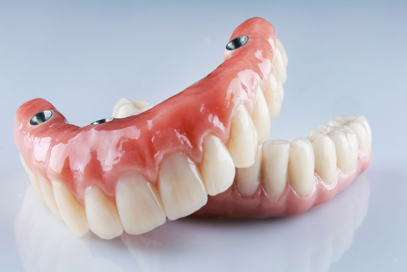 a set of full arch dental implant model.