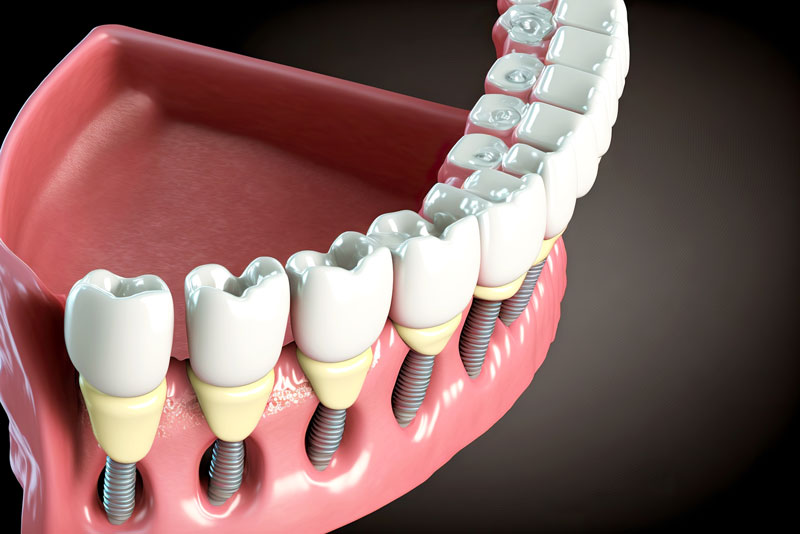 3d model of a full mouth of dental implants