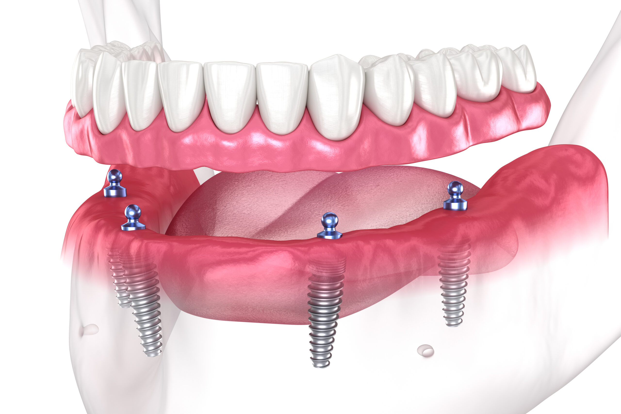 Dental prosthesis based on 4 implants. Dental 3D illustration