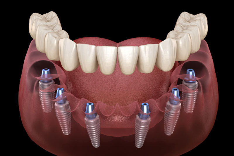 a full mouth dental implant model that shows patients how a healthy jawbone can support the dental implants and prosthesis in a full mouth dental implant procedure.