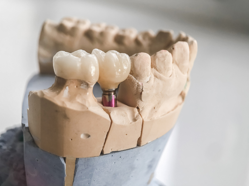 Transform your smile with our dental implants. A long-lasting solution for tooth loss, offering natural aesthetics and functionality. Contact us today!