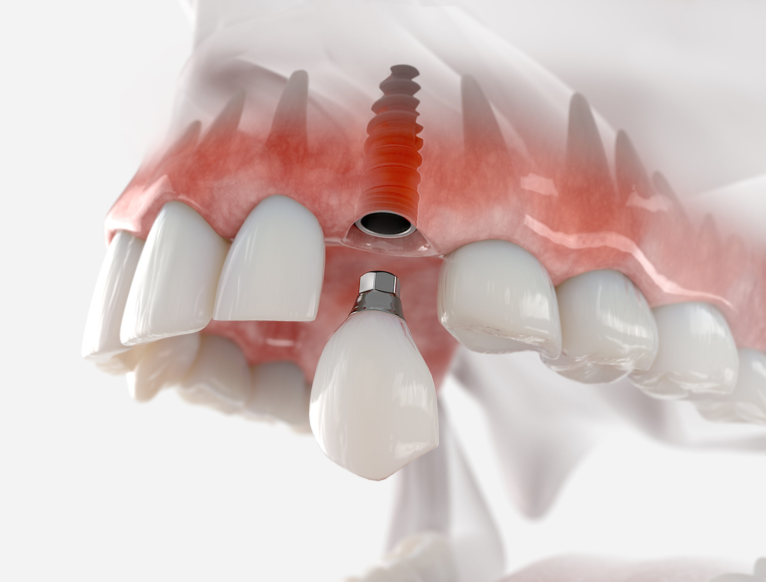 Replacement of maxillary canine with a dental implant. Realistic 3d illustration.