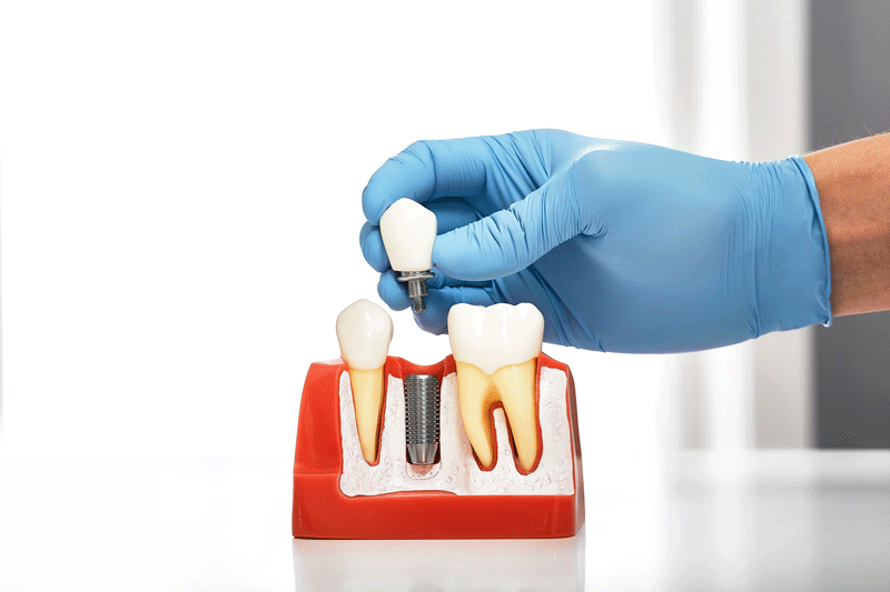 Dentist showing the installation of a dental implant on the anatomical model of teeth.
