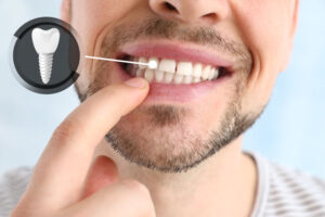 a man pointing at a dental implant in his mouth.