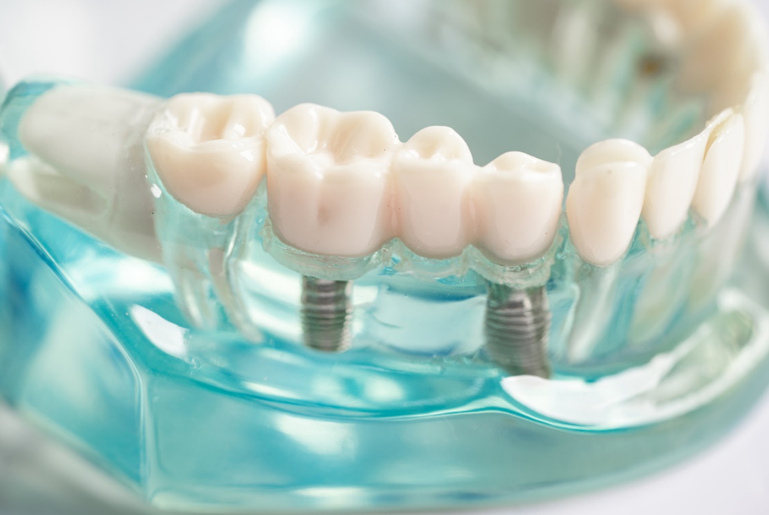 Dental implants transform smiles, Dental implants