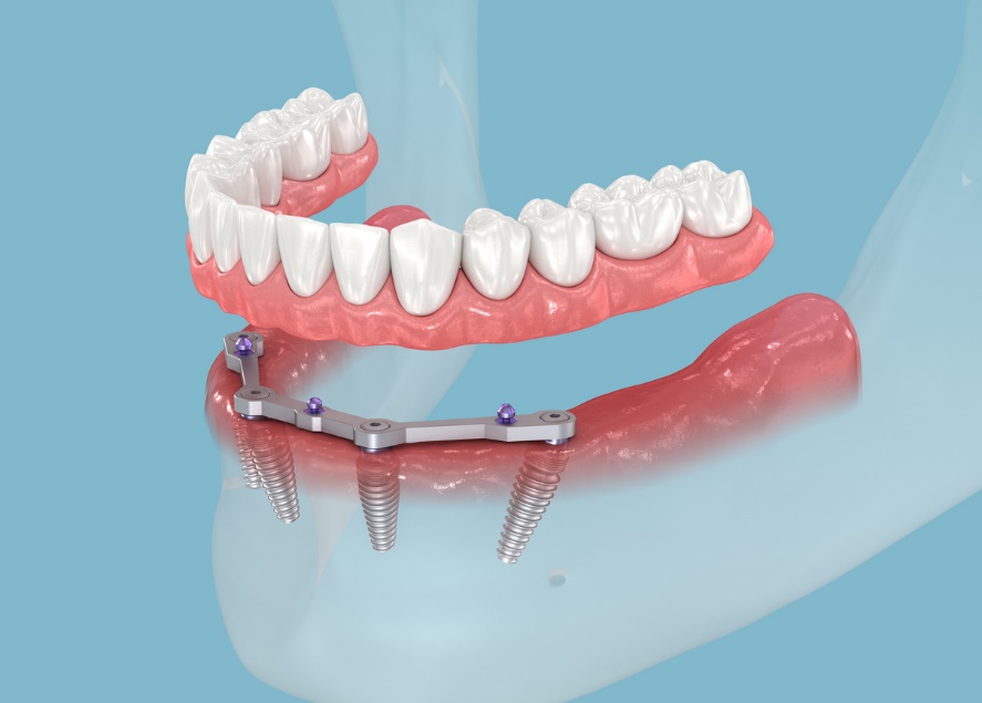 dental implants, Teeth scan image