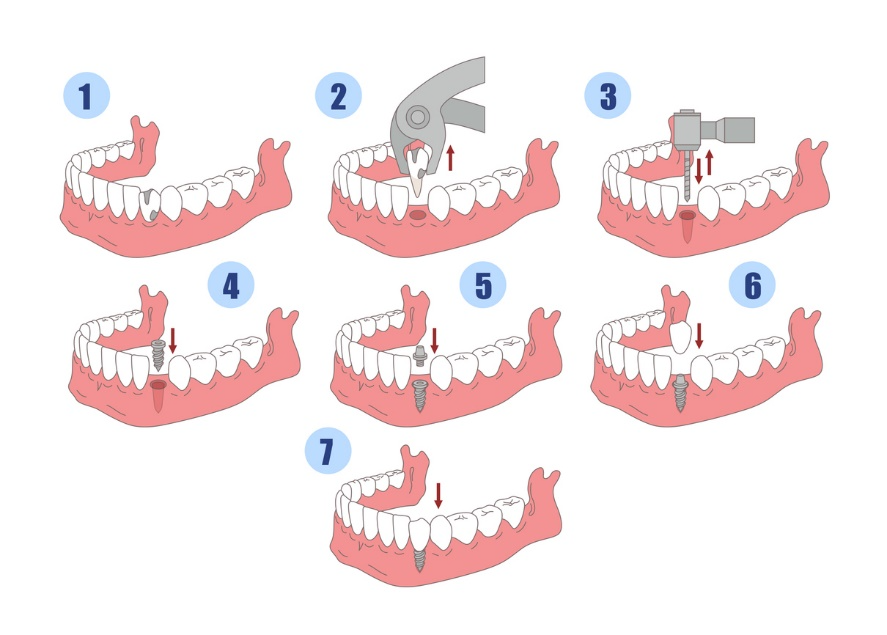 Step-by-step illustration showing the dental implant process from tooth extraction to implant placement and final restoration.